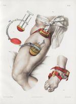 Planche 21 - Compression des artères du membre abdominal - Traité complet de l'anatomie de l'homme,  [...]