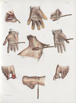 Planche 23 - Opérations et instruments - Opérations diverses - Traité complet de l'anatomie de l'hom [...]