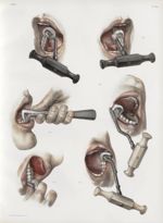 Planche 24 - Extraction des dents - Traité complet de l'anatomie de l'homme, par les Drs Bourgery et [...]
