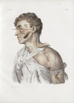 Planche 30 - Artériotomie. Saignée des veines jugulaire et céphalique - Traité complet de l'anatomie [...]