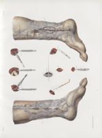 Planche 31 - Opérations qui se pratiquent sur les vaisseaux sanguins - Traité complet de l'anatomie  [...]
