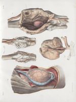 Planche 33 - Anatomie pathologique chirurgicale. Divers cas d'anévrismes - Traité complet de l'anato [...]