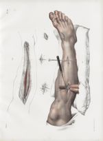 Planche 36 - Ligature des artères tibiale antérieure et pédieuse - Traité complet de l'anatomie de l [...]