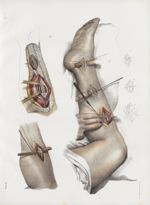 Planche 37 - Ligature des artères tibiale postérieure et péronière - Traité complet de l'anatomie de [...]