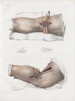 Planche 38 - Ligature de l'artère poplitée - Traité complet de l'anatomie de l'homme, par les Drs Bo [...]