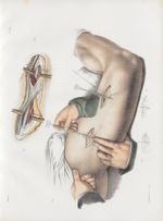 Planche 39 - Ligatures de l'artère fémorale - Traité complet de l'anatomie de l'homme, par les Drs B [...]