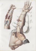 Planche 40 - Ligatures des artères cubitale, radiale et humérale - Traité complet de l'anatomie de l [...]