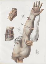 Planche 41 - Ligature des artères cubitale, radiale, et humérale - Traité complet de l'anatomie de l [...]