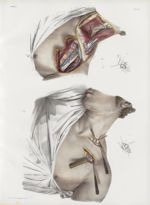 Planche 43 - Ligature des artères sous-clavière et axillaire - Traité complet de l'anatomie de l'hom [...]