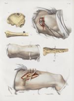 Planche 49 - Solutions de continuité des os - Traité complet de l'anatomie de l'homme, par les Drs B [...]