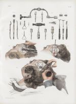 Planche 53 - Trépanation des os du crâne et instruments du trépan - Traité complet de l'anatomie de  [...]