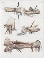 Planche 56 - Diverses résections des os du membre thoracique - Traité complet de l'anatomie de l'hom [...]