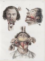 Planche 65 - Résections de la mâchoire inférieure - Traité complet de l'anatomie de l'homme, par les [...]