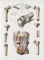 Planche 66 - Résultats des amputations - Traité complet de l'anatomie de l'homme, par les Drs Bourge [...]