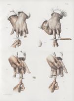 Planche 67 - Amputations sur la main - Amputations des phalanges - Traité complet de l'anatomie de l [...]