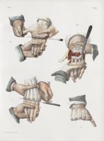 Planche 69 - Amputations du métacarpe - Traité complet de l'anatomie de l'homme, par les Drs Bourger [...]