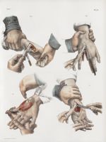 Planche 70 - Amputations sur la main - Traité complet de l'anatomie de l'homme, par les Drs Bourgery [...]