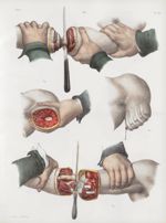Planche 73 - Amputations sur le membre thoracique - Traité complet de l'anatomie de l'homme, par les [...]