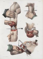 Planche 74 - Amputations sur le membre thoracique - Traité complet de l'anatomie de l'homme, par les [...]