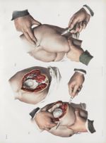 Planche 77 - Amputations dans l'articulation scapulo-humérale - Traité complet de l'anatomie de l'ho [...]