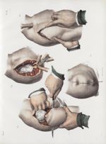 Planche 78 - Amputations ovalaires dans l'articulation scapulo-humérale - Traité complet de l'anatom [...]