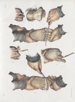 Planche 79 - Amputations des orteils - Traité complet de l'anatomie de l'homme, par les Drs Bourgery [...]