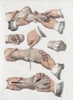 Planche 80 - Amputations du métatarse - Traité complet de l'anatomie de l'homme, par les Drs Bourger [...]