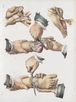Planche 81 - Amputations sur le pied - Traité complet de l'anatomie de l'homme, par les Drs Bourgery [...]