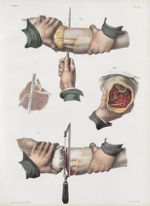 Planche 82 - Amputation de la jambe - Traité complet de l'anatomie de l'homme, par les Drs Bourgery  [...]