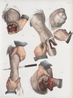 Planche 83 - Amputations de la jambe - Traité complet de l'anatomie de l'homme, par les Drs Bourgery [...]
