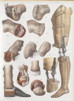 Planche 83 bis - Amputations du pied et de la jambe - Traité complet de l'anatomie de l'homme, par l [...]