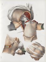 Planche 87 - Amputations dans l'articulation coxo-fémorale - Traité complet de l'anatomie de l'homme [...]