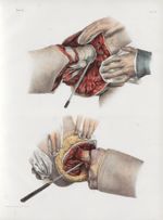 Planche 90 - Amputations dans l'articulation coxo-fémorale - Traité complet de l'anatomie de l'homme [...]