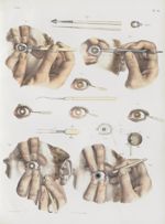 Planche 10 - Opération de la cataracte. Extraction et abaissement - Traité complet de l'anatomie de  [...]
