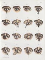 Planche 11 - Opérations de pupilles artificielles - Traité complet de l'anatomie de l'homme, par les [...]