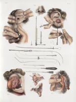 Planche 12 - Opérations qui se pratiquent sur l'oreille - Traité complet de l'anatomie de l'homme, p [...]