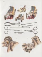 Planche 13 - Opérations qui se pratiquent sur l'oreille - Traité complet de l'anatomie de l'homme, p [...]