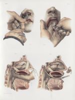 Planche 15 - Polypes des fosses nasales - Traité complet de l'anatomie de l'homme, par les Drs Bourg [...]