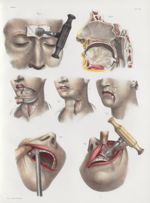 Planche 16 - Génoplastique. Opérations qui se pratiquent sur les fosses nasales - Traité complet de  [...]