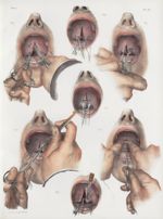 Planche 22 - Opération de la staphyloraphie - Traité complet de l'anatomie de l'homme, par les Drs B [...]
