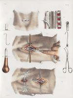 Planche 25 - Laryngotomie et trachéotomie - Traité complet de l'anatomie de l'homme, par les Drs Bou [...]