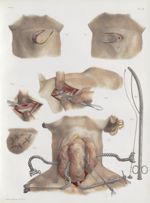 Planche 26 - Bronchoplastique, goitre, oesophagotomie - Traité complet de l'anatomie de l'homme, par [...]