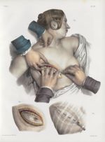 Planche 27 - Ablation du sein - Traité complet de l'anatomie de l'homme, par les Drs Bourgery et Cla [...]