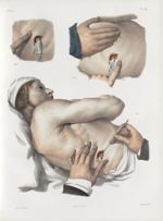 Planche 28 - Opération de l'empyème - Traité complet de l'anatomie de l'homme, par les Drs Bourgery  [...]