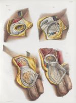 Planche 38 - Anatomie chirurgicale des hernies - Traité complet de l'anatomie de l'homme, par les Dr [...]