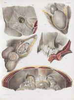 Planche 39 bis - Divers cas de hernies - Traité complet de l'anatomie de l'homme, par les Drs Bourge [...]
