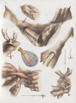 Planche 40 - Procédés opératoires des hernies - Procédés pour la guérison des hernies réductibles -  [...]