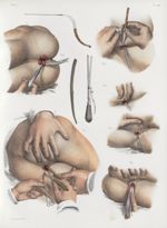 Planche 44 - Fistules à l'anus et tumeurs hémorroïdales - Traité complet de l'anatomie de l'homme, p [...]