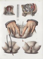 Planche 46 - Opérations sur le rectum - Traité complet de l'anatomie de l'homme, par les Drs Bourger [...]
