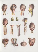 Planche 53 - Maladies de l'urètre, de la prostate et de la vessie - Traité complet de l'anatomie de  [...]